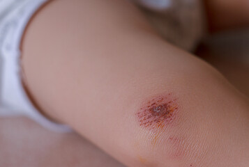 A close-up of a scabbed scab on the knee of a child caused by a fall accident.