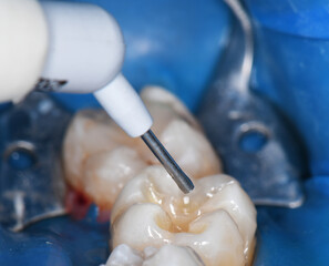 tooth cavity treatment with light cure composite