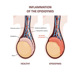 Inflammation of the epididymis. comparison and difference of Healthy testicle and testicle with infection. Signs and symptoms of the disease © nmfotograf