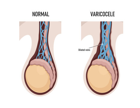 Varicocele Images – Browse 374 Stock Photos, Vectors, and Video