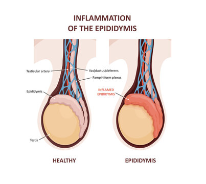 Inflammation of the epididymis. comparison and difference of Healthy testicle and testicle with infection. Signs and symptoms of the disease