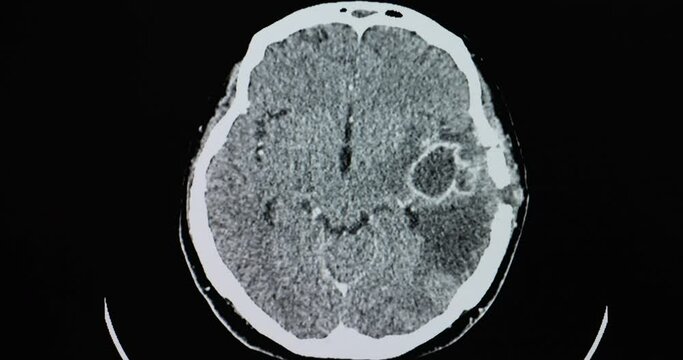 A CT brain scan of a patient with large brain abscesses in her left temporal lobe.