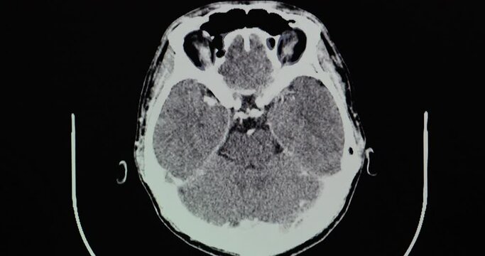 A CT brain scan with contrast of a patient with rim enhancing lesion with peri-lesional brain edema at right frontal lobe. Differential diagnosis includes brain abscess or primary brain tumor.