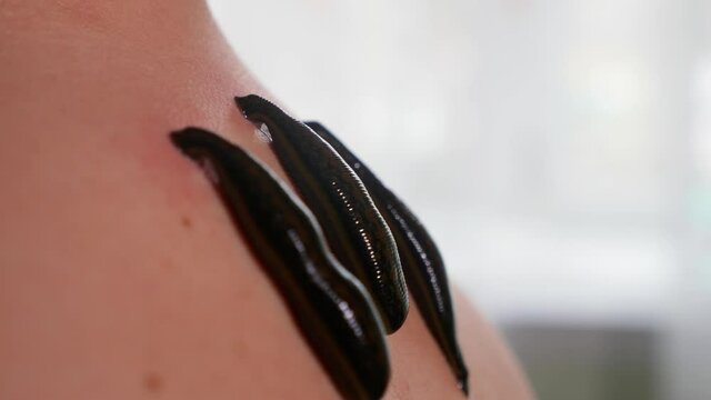 Three leeches on patient's neck, close-up. Hirudotheraphy concept. High quality 4k footage