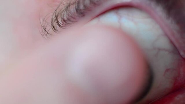 A man with myopia puts a contact lens on his eye. 