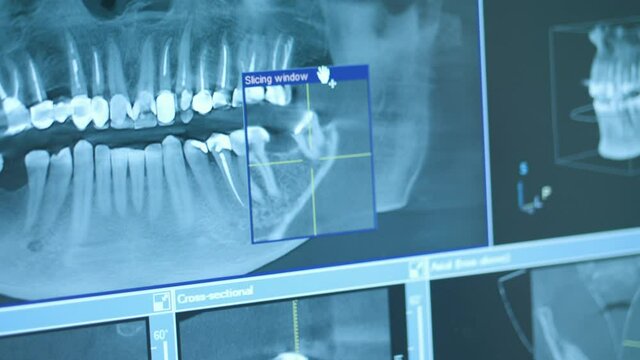 Close-up of doctor dentist looks at looks 3d model of x-rays of the patient's jaw and teeth on the monitor, modern dentistry