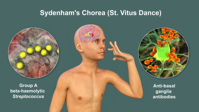 Sydenham's chorea, an autoimmune disease that results from Streptococcus infection