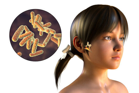 Otitis media, inflammatory disease of the middle ear