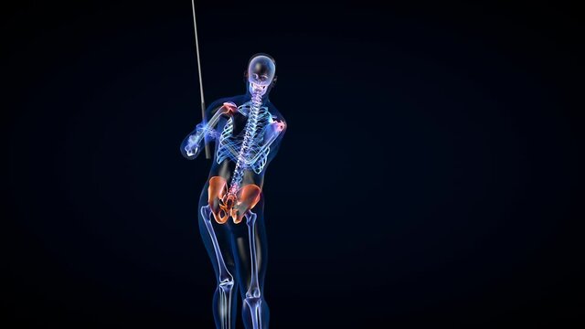 Athlete X-Ray Hitting A Golf Ball, Zoom On Pain Area