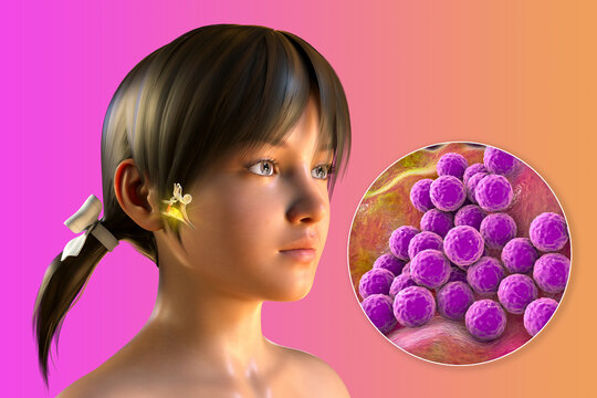 Staphylococcus aureus bacterium as a cause of otitis media