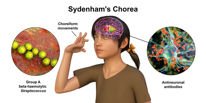 Sydenham's chorea, an autoimmune disease that results from Streptococcus infection