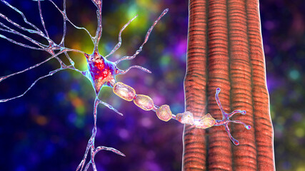 Demyelination of neuron, the damage of the neuron myelin sheath seen in demyelinating diseases