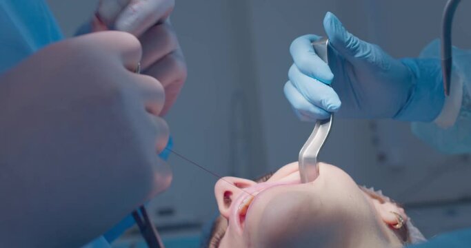 The close-up face of the female patient is having a teeth treatment by the dentist who is using a dental forceps with the surgical thread while an assistant is holding a cheek retractor.