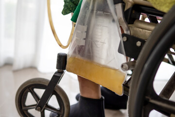 Asian lady woman patient sitting on wheelchair with urine bag in the hospital ward, healthy medical...