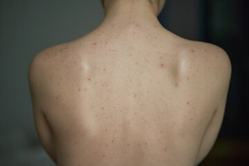 Female back with acne. Skin care problems. Young girl with allergy on her skin. Dermatology concept
