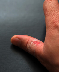 skinning skin between the fingers, the hands of one person injured,
