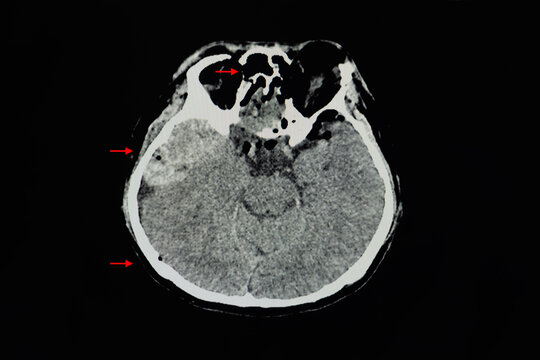A CT brain scan of a patient with multiple fractures, epidural hematoma, and pneumocephalus.