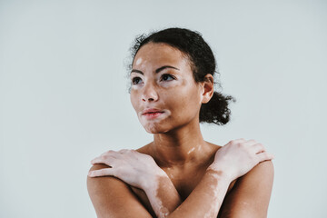 Beautiful woman with vitiligo skin posing in studio. Concept about body positivity and self...