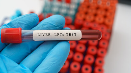 Liver function LFTs  test result with blood sample in test tube on doctor hand in medical lab