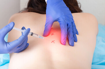 Cerebrospinal injection with ozone to relieve pain and inflammation in the back. Treatment of...