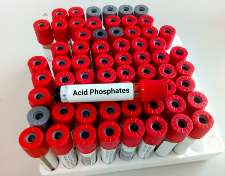 Blood Sample For Acid Phosphatase Enzyme Test. Health And Medical Testing Concept