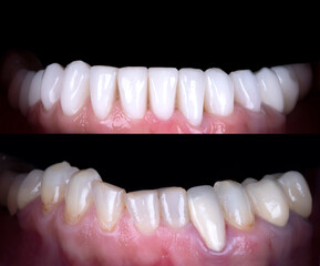 after, beautiful, beauty, before, bleach, care, caries, cavity, ceramic, clean, clear, clinic,...