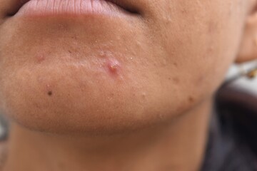 acne or pimple on face closeup
