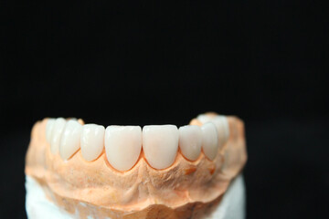 Fototapeta na wymiar Dental veneers in the plaster model. Smile makeover