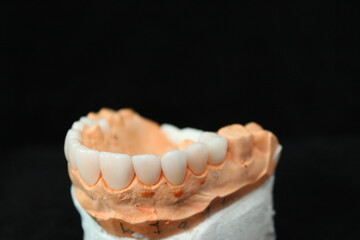 Dental veneers in the plaster model. Smile makeover