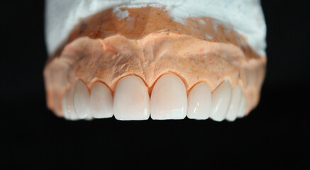 Dental veneers in the plaster model. Smile makeover