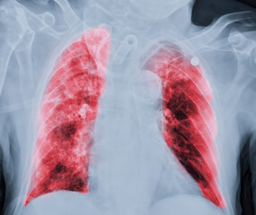 Chest X-ray or X-Ray Image Of Human Chest or Lung ( red zone ) showing tuberculosis