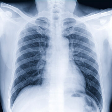 Chest X-ray or X-Ray Image Of Human Chest for a medical diagnosis . check up concept.