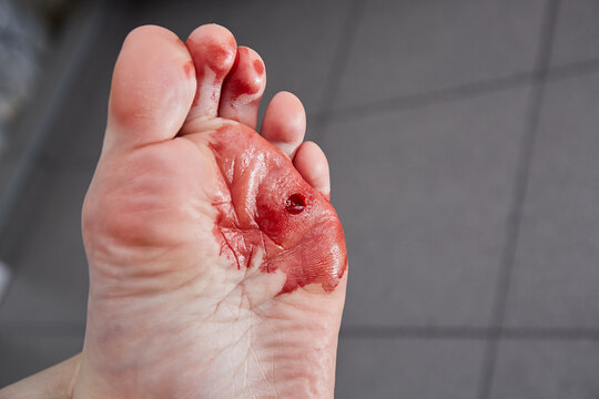 Laser removal of wart from the foot. Cut out verruca. Immediately after surgery. Blood flows from the wound. Human papilloma virus. Close-up. Copy space. Macro. Infectious skin disease. HPV. Medicine