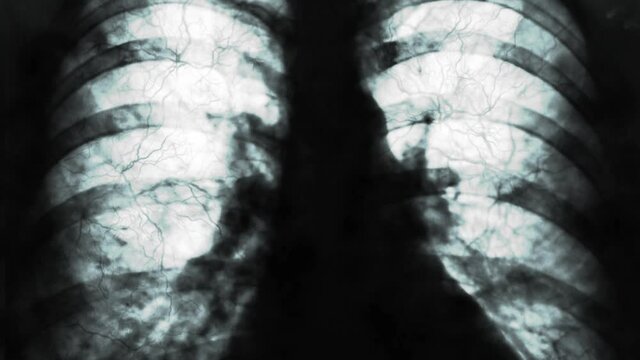 X-rays of the human lungs or physical therapy for doctors with lung problems Such as viruses entering the lungs, etc