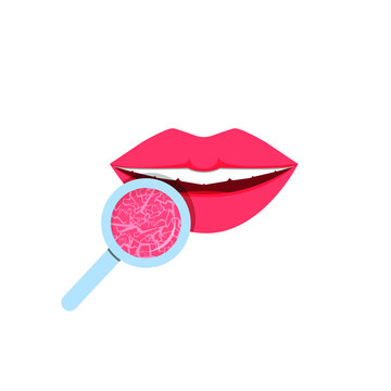 Dry lips. Women's lips are pink. An area of skin under a magnifying glass looks dry and cracked. Vector illustration, flat cartoon design. isolated on white background, eps 10.