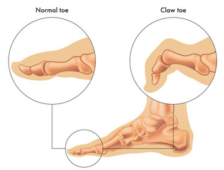 Medical illustration shows the difference between a normal toe and a claw toe, with annotations. - obrazy, fototapety, plakaty