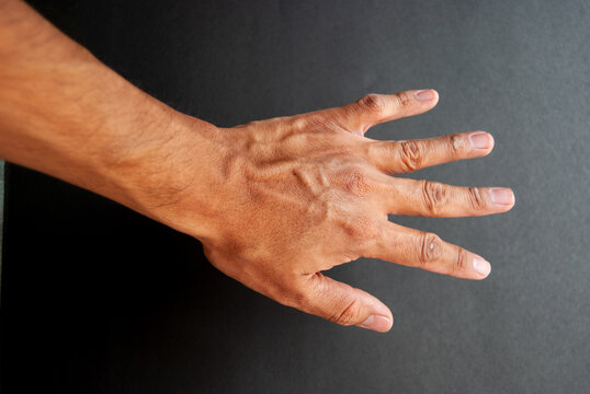 Bulging Veins In Hand Of A Man On Black Background