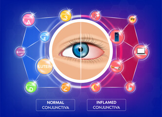 Normal conjunctiva and Risky behaviors for eye inflammation (Conjunctivitis). Nourish the eyes with vitamins, omega 3, lutein. Human eye anatomy in front view. 3D Vector EPS10 illustration
