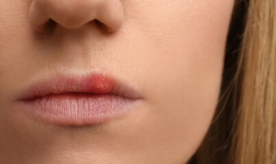 Obraz premium Woman suffering from herpes, closeup. Dermatological problem