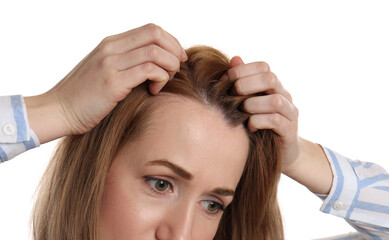 Fototapeta premium Woman suffering from baldness on white background, closeup