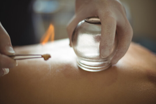 Hands of therapist performing cupping therapy, heating jar held on the back of patient