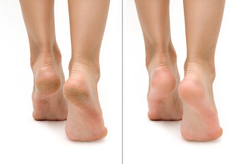 Feet with dry skin before and after treatment. comparison of a dry heel and a healthy foot. keratinized skin on the foot. treatment of corns - obrazy, fototapety, plakaty