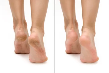 Muurstickers Feet with dry skin before and after treatment. comparison of a dry heel and a healthy foot. keratinized skin on the foot. treatment of corns © Асель Иржанова