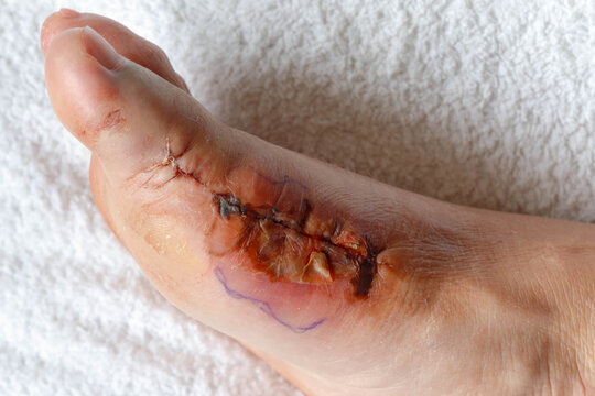 Health care and foot surgery, Wound infection after operation, Lesion with hematoma or contusion, Problem of right side feet with a bunion (referred to as hallux valgus or hallux abducto valgus)