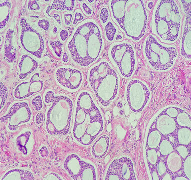 Photo of adenoid cystic carcinoma, showing cribriform pattern, magnification 200x, photo under microscope