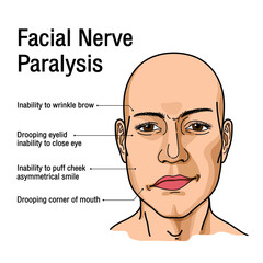 Fototapeta premium Paralysis of the facial nerve. Bell's palsy. Vector
