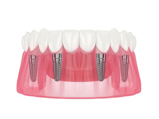 Mandibular prosthesis all on 4 system supported by implants