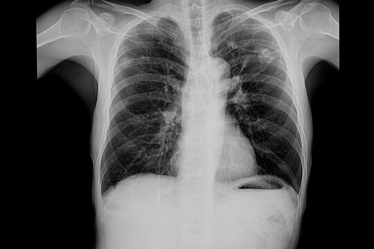 Chest xray of a patient with old TB