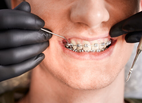 Close up of dentist hands putting elastic rubber band on patient brackets. Man with wired metal braces on teeth receiving orthodontic treatment in dental clinic. Concept of dentistry and orthodontics.