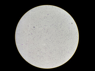Haematological (CBC) blood film show neutrophilic leucocytosis picture form microscopic 40x...